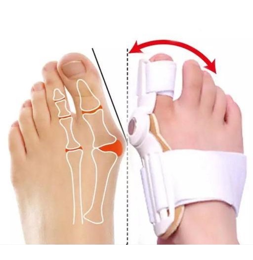 هالوکس والگوس